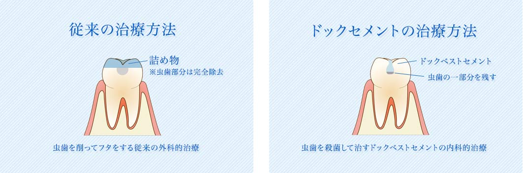 従来とドックセメントのの治療方法