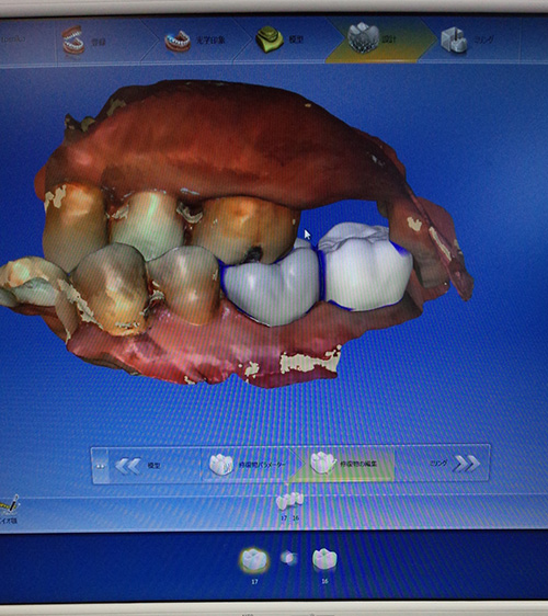 3Dカメラで口腔内を撮影