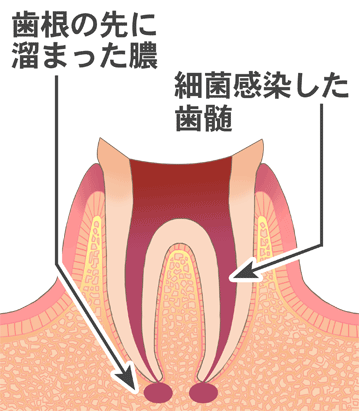 歯根の先に溜まった膿