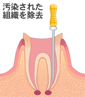 汚染された組織を除去