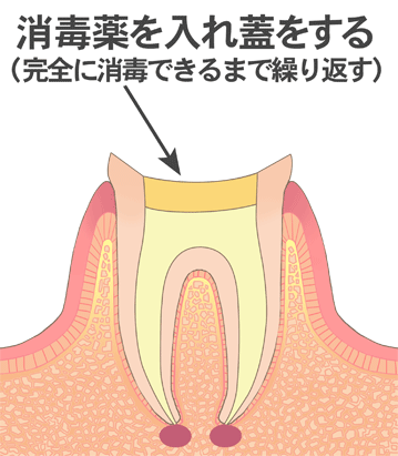 消毒薬を入れ蓋をする