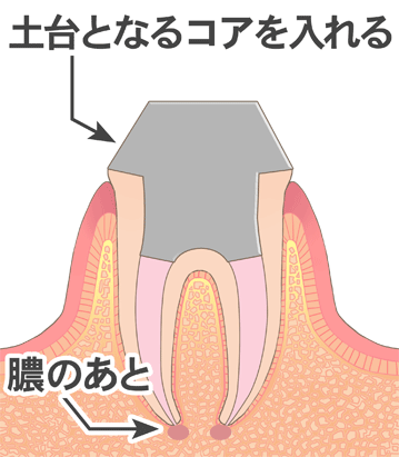 土台となるコアを入れる