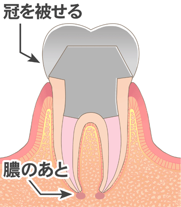 冠を被せる