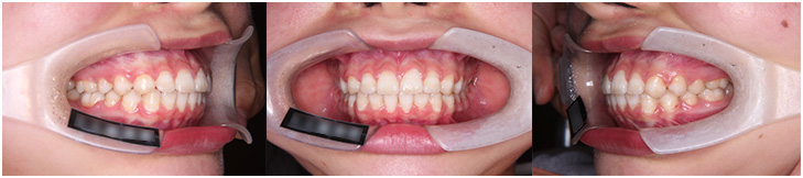 orthodontic_03 動的治療終了時口腔内写真