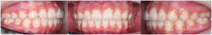 orthodontic_05 動的治療終了時口腔内写真(拡大図)