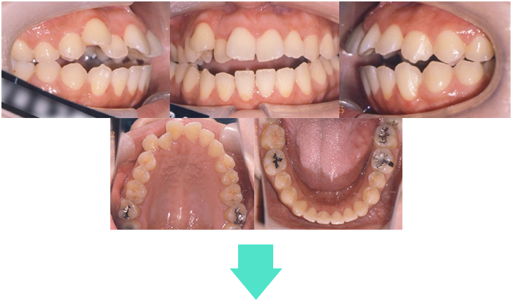 orthodontic_06-1 術前口腔内写真