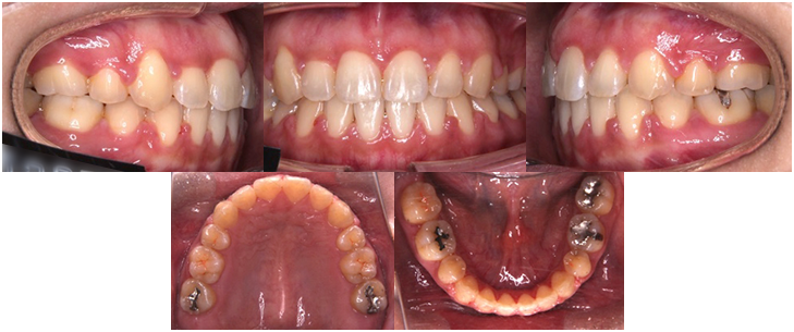 orthodontic_07 動的治療終了時口腔内写真
