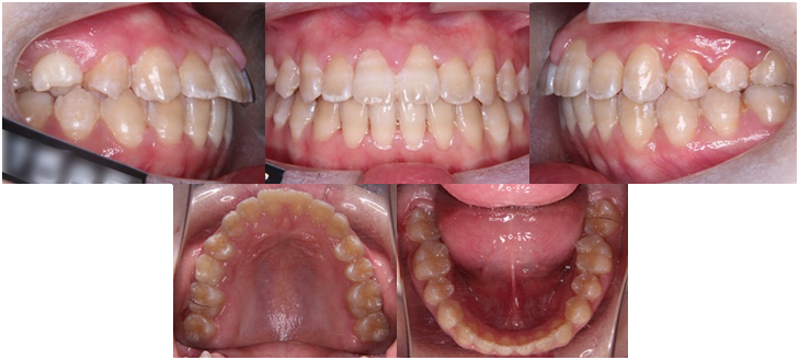orthodontic_09 動的治療終了時口腔内写真