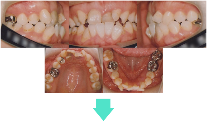 orthodontic_10 術前口腔内写真