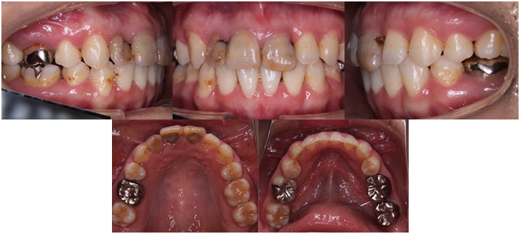 orthodontic_11 動的治療終了時口腔内写真