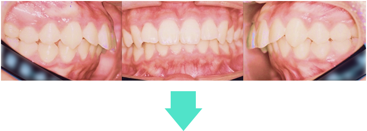 orthodontic_12 術前口腔内写真