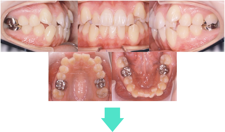 orthodontic_14 術前口腔内写真