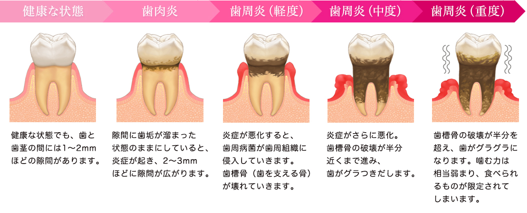 炎 治療 歯肉 歯肉炎について